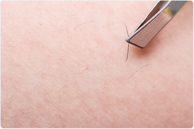 Ingrown Hair Causes Symptoms Treatments Infections