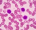 FDA approves new treatment for people with hairy cell leukemia