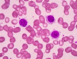 Oral targeted therapy found to be an effective treatment option for high-risk hairy cell leukemia