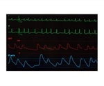 Common heart rhythm abnormality along with other health conditions linked to greater risk of mortality