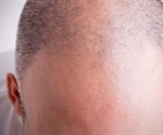 Study reveals link of male-pattern baldness and premature graying with early heart disease