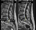 Less invasive therapy relieves low back pain, study states