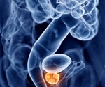 Researchers adopt new approach to treating advanced prostate cancer