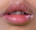 Angular Cheilitis causes and treatments