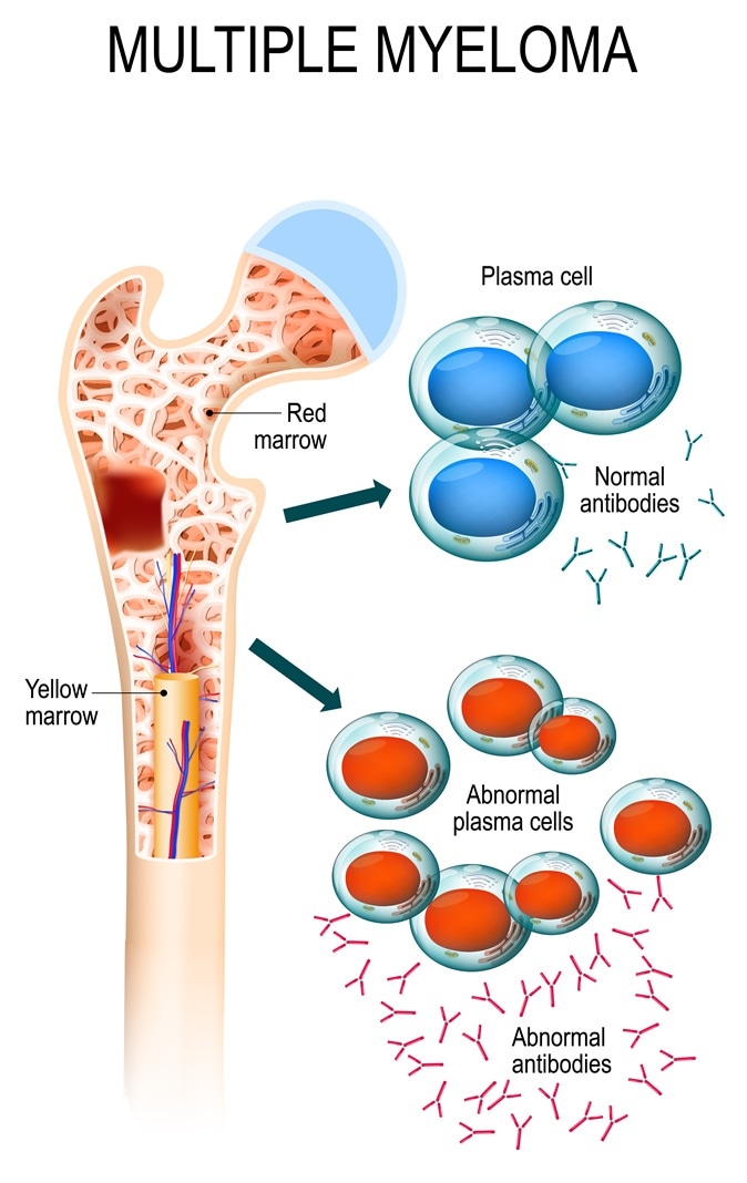 Multiple myeloma is a cancer of the bone marrow. healthy plasma cells in the bone marrow mutate and multiply uncontrollably. malignant plasma cells produce a paraprotein. Image Credit: Designua / Shutterstock