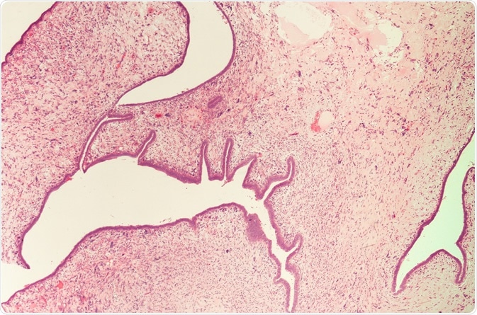 Round Corners and Add Border:	 ALT:	 Caption:	 Photomicrograph (microscopic image) from breast mastectomy specimen showing a malignant phyllodes tumor (cystosarcoma phylodes). Image Credit: David Litman / Shutterstock Save & Insert