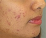 Acne affects self-confidence of many teenagers, survey finds