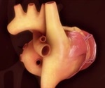 Types of Congenital Heart Defects