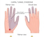 Pins and Needles and Carpal Tunnel Syndrome