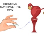 Advantages and Disadvantages of the Contraceptive Vaginal Ring