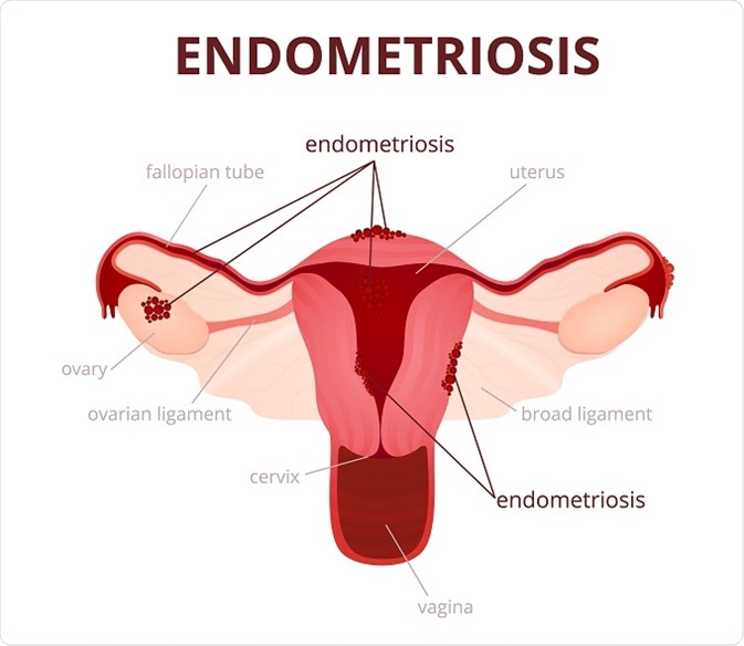Endometriosis happens when tissue similar to the lining of the