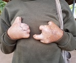 New test for leprosy gives results in less than 10 minutes, New York Times reports