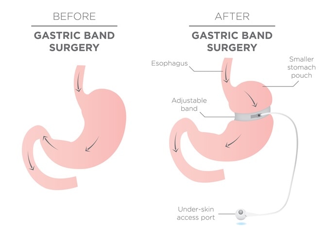 Gastric Band for Weight Loss. Image Credit: bearsky23 / Shutterstock