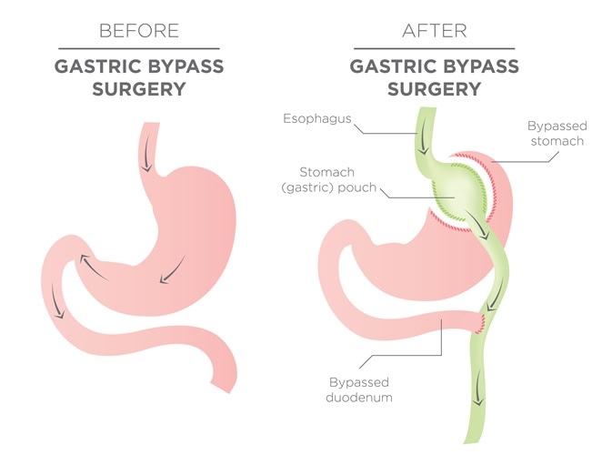 Gastric Bypass for Weight Loss - Image Credit: bearsky23 / Shutterstock