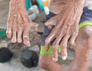 Better education for patients, doctors on disease symptoms may help reduce leprosy in Brazil