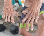 Leprosy Stigma