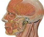 What is Facial Palsy?