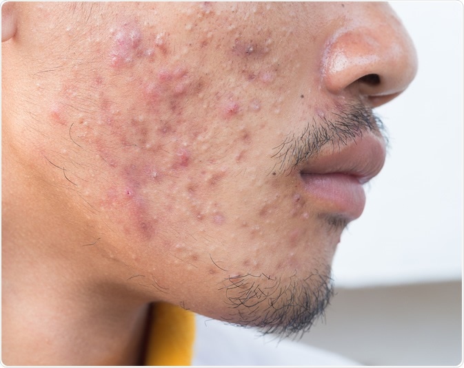 Man with problematic skin and scars from acne. Image Credit: frank60 / Shutterstock
