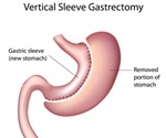 What does Sleeve Gastrectomy Involve?