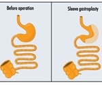 Complications of Sleeve Gastrectomy