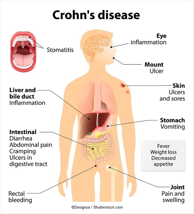 Crohn's disease  Symptoms, Genetic Testing