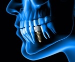 New titanium dental implant
