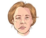 Surgical Options for Facial Palsy