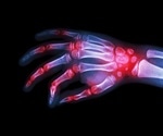 Researchers discover key details of how rheumatoid arthritis destroys bone