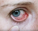 How is Conjunctivitis Diagnosed?
