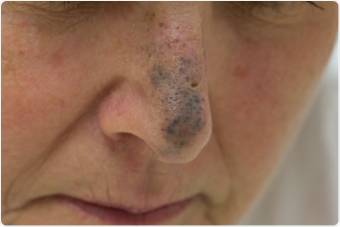 Blue Nevus on the Nose of a Female - Image Credit: Anthony Ricci / Shutterstock