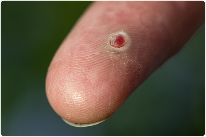 Pyogenic granuloma bloody wound on a finger - Image Credit: CLS Digital Arts / Shutterstock