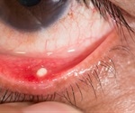 What Causes Conjunctivitis?