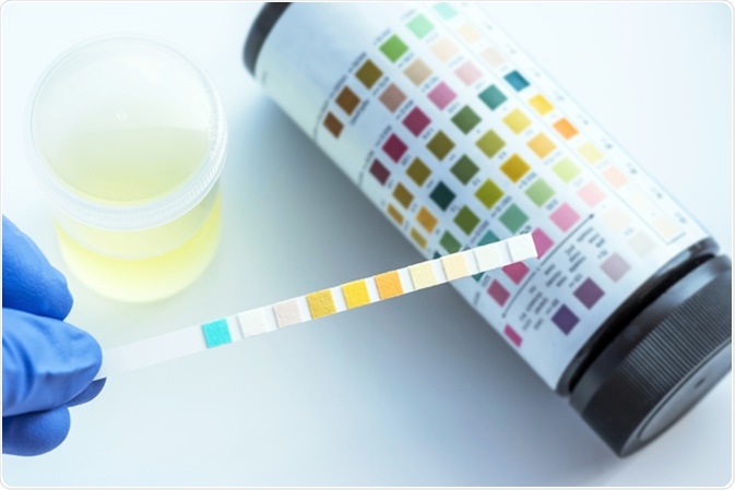 Reagent Strip for Urinalysis - Image Credit: Sirirat / Shutterstock