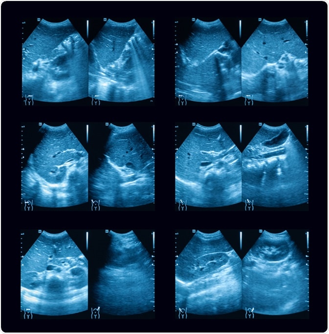 Ultrasound of upper abdomen, post splenectomy, a 16 young Asian boy - Image Credit: Suttha Burawonk / Shutterstock