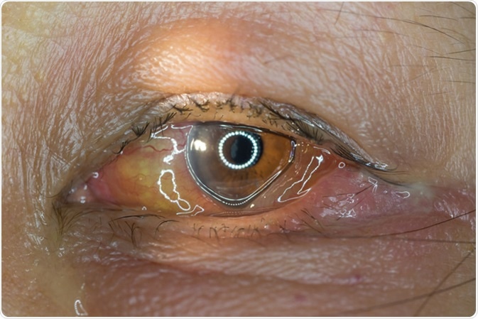 Close up of eye infection during eye examination. Conjunctivitis, episcleritis. Image Credit: ARZTSAMUI / Shutterstock