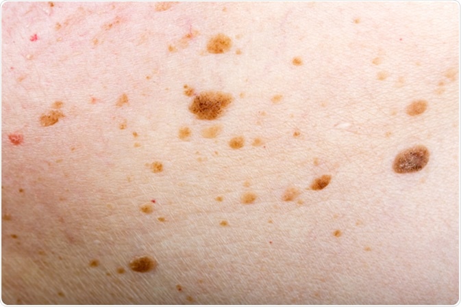 Nevus on human skin - Image Credit: Ocskay Bence / Shutterstock