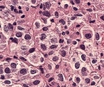 Three different leukemias are all caused by mutations that alter a specific enzyme controlling blood cell proliferation