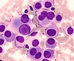 Researchers present clinical outcomes of lenalidomide in patients with large B-cell lymphoma