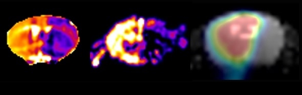 Brain stroke model. Left to right: MRI (ADC map), MRI (Perfusion), 18F FDG PET. Conventionally ischemic penumbra is determined based on perfusion/diffusion mismatch. PET FDG enables mapping of the metabolism.