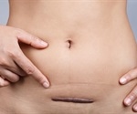 UC San Diego surgeon removes diseased gallbladder through belly button