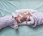 Twin girls joined at the head separated successfully by team of doctors at CHOP