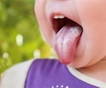 Oral Thrush in Babies