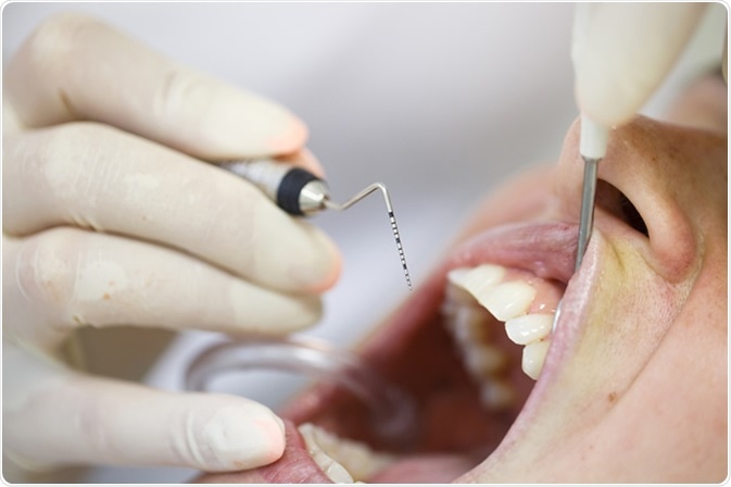 Periodontal probe, held by dental hygienist. Image Credit: zlikovec / Shutterstock