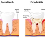 Prevention of Periodontitis