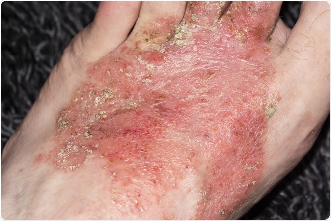 Eczema on the foot - Image Credit: Lapis2380 / Shutterstock