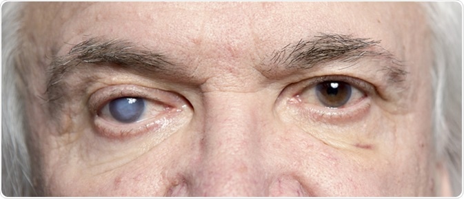 Glaucoma - Image Credit:  Sergei Primakov / Shutterstock