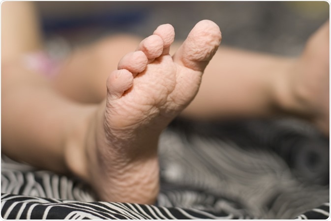 Toes wrinkled after bath - Image Credit: Taratorki / Shutterstock