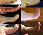 Genetics of Hitchhiker's Thumb