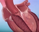 Hypertrophic Cardiomyopathy (HCM)
