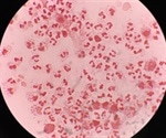Rise in antibiotic-resistant gonorrhea, WHO report reveals